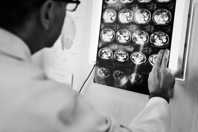 Intracranial Tuberculomas