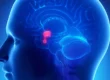 Pituitary Tumor