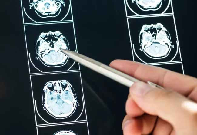 types of brain injuries
